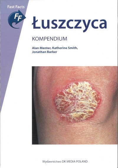 Łuszczyca Łuszczyca